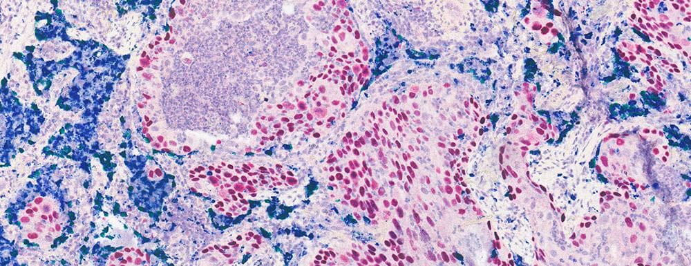 Lung - Squamous cell Carcinoma 3-Plex